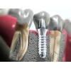 Стоматология Протезирование, имплантация зубов